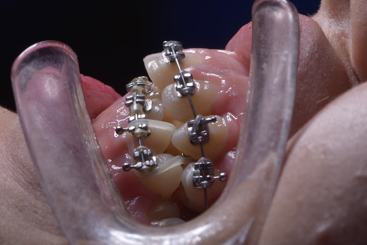crown dental care