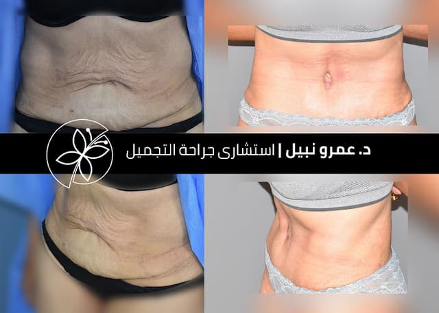 Dr. Amr Nabil Plastic Surgery Hub ا.د/ عمرو نبيل استشاري جراحة التجميل