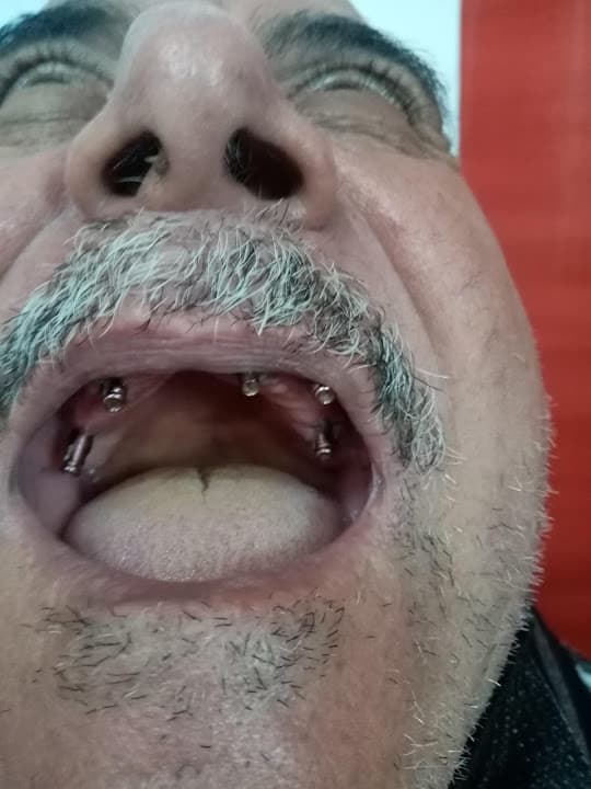 O-MFS Dr.Elsherbini Elshal مركز د/ الشربيني الشال لجراحات الوجه والفكين