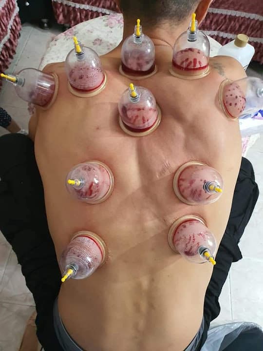 اخصائي حجامه وتأهيل حركي